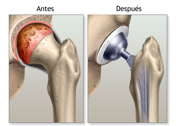 reemplazo-de-cadera-traumatolog-a-roca